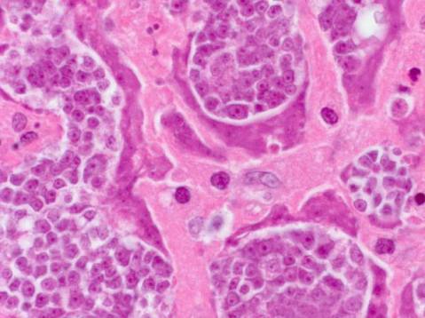 דגימת רקמה מגידול בבלוטת לימפה של חולה, שבה רואים תאים סרטניים שמקורם בתולעת טפילית